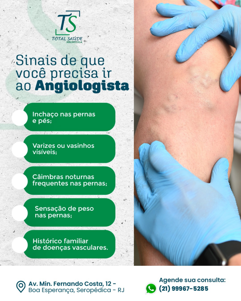 Varizes nas Pernas: quando procurar um angiologista e como tratar
